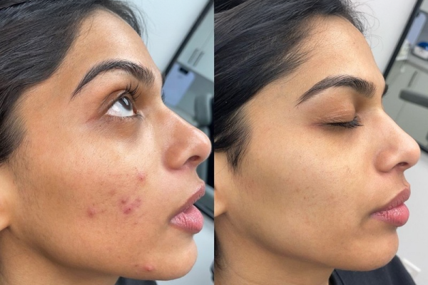 aerolase-safe-acne-treatment-indian-skin_2_