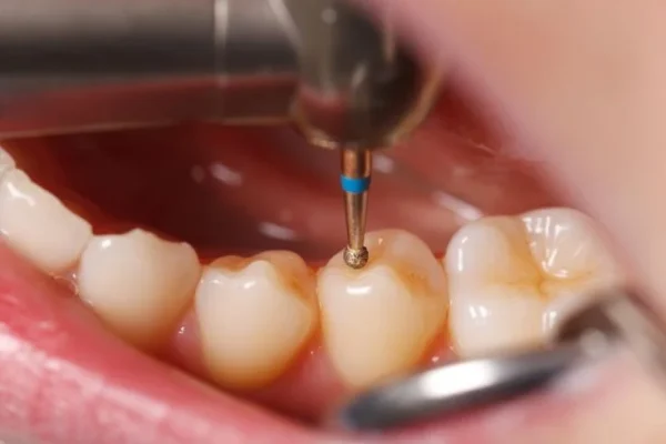 dental-fillings-procedure.jpeg