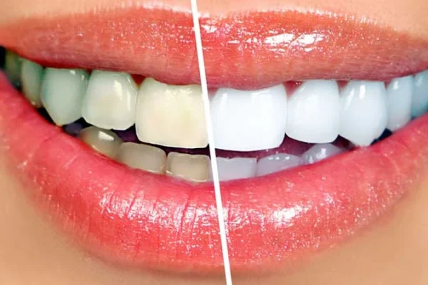 tooth-whitening